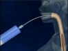 thumbs balon intragastrico 5 balon gastrico