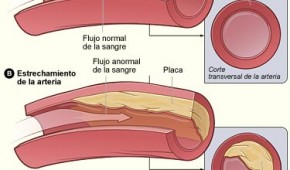 La enfermedad Coronaria y la obesidad