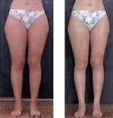 Depresoterapia en la celulitis