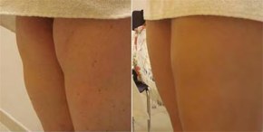 Lipoatrofia semicircular en piernas