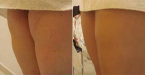 Lipoatrofia semicircular en piernas