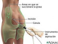 Liposuccion, la grasa vuelve