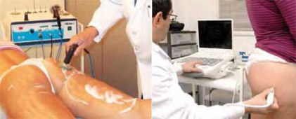 Radiofrecuencia para la celulitis