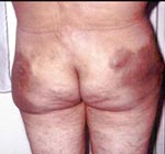 rellenos esteticos